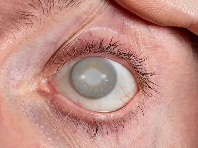 cataratta oculista roma